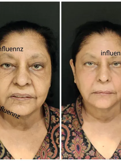 This before and after shows a liquid facelift transformation. This non-surgical treatment uses fillers to restore volume and lift the face, creating a more youthful and refreshed appearance.