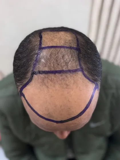 A top-down view of the head with the transplant areas marked for a 5400 graft procedure.