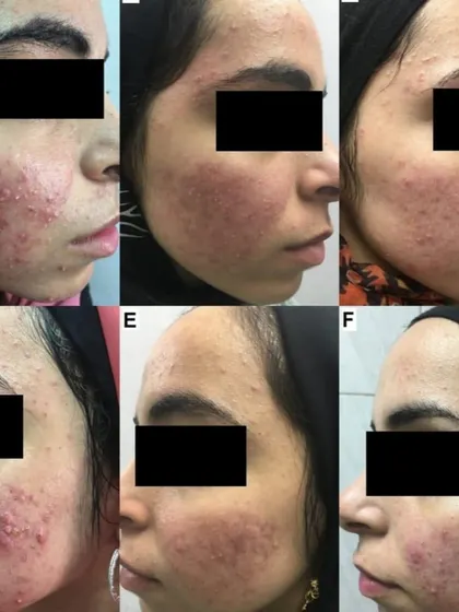 This progression collage shows the journey from active inflammatory acne to clearer skin. The treatment involved managing the breakouts first with medical therapy, followed by addressing the post-inflammatory marks and texture with targeted procedures.