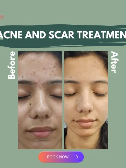 Real results for a real client. This before and after image demonstrates the effectiveness of our customized acne and scar treatment plan. We combine advanced procedures to significantly reduce active acne, clear up post-inflammatory hyperpigmentation, and smooth skin texture.