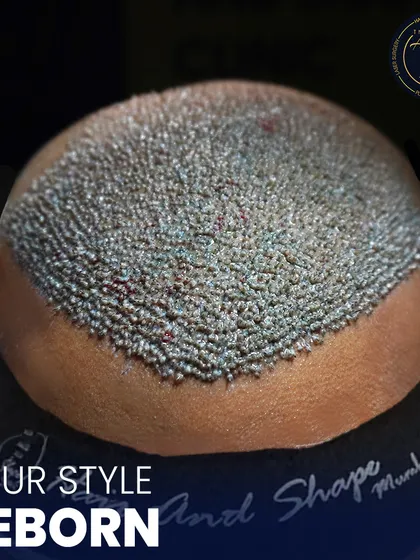 This is where science meets style. A detailed view of newly implanted hair follicles, showcasing the meticulous process of high-density hair restoration.