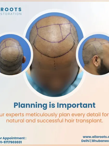 Planning is everything. This image shows the detailed mapping I do on a patient's scalp before surgery. This meticulous planning is crucial for achieving a natural and successful hair transplant.