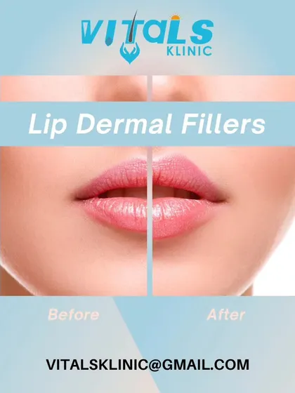 This before-and-after shows a lip enhancement using dermal fillers. The goal is to create a balanced, hydrated, and naturally fuller appearance, tailored to the patient's facial anatomy.