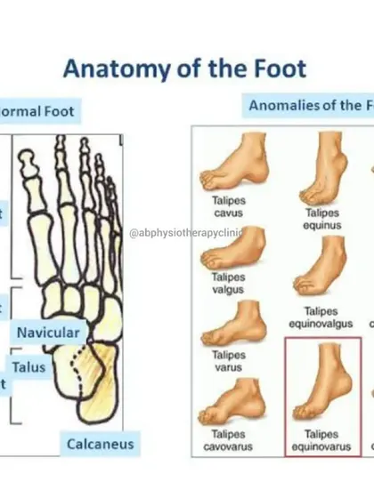 The human foot is complex, and many anomalies can cause pain or affect your gait. This chart compares a normal foot structure to various deformities, such as Talipes equinovarus (clubfoot), which we can help manage.