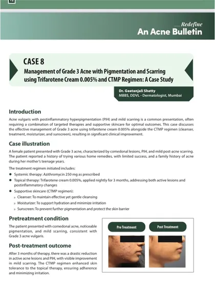 Case Study: Managing Grade 3 Acne. This is a page from a medical bulletin where I authored a case study on treating severe acne with pigmentation and scarring using a combination of therapies, including Trifarotene cream.