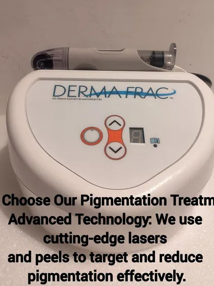 This is the advanced Dermafrac system we use for many of our skin rejuvenation treatments. This US FDA-approved technology combines microneedling with the simultaneous infusion of targeted serums, allowing us to effectively treat pigmentation, acne scars, and signs of aging.