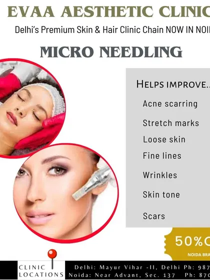 A summary of the conditions that Micro-Needling helps improve. This treatment is effective for reducing acne scarring, stretch marks, loose skin, fine lines, wrinkles, and improving overall skin tone.