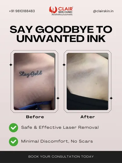 A fresh start for your skin is possible. This before and after shows the complete removal of a "Stay Gold" collarbone tattoo using our advanced laser technology. We effectively fade the ink until it's gone, leaving behind clear skin with minimal discomfort and no scarring.
