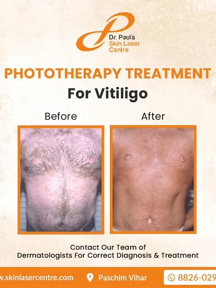 This before and after image shows the results of NB-UVB phototherapy on the chest and abdomen. This is a safe and time-tested treatment that involves exposing the skin to a specific wavelength of ultraviolet light to encourage repigmentation. It is a reliable option for various cases, including for children.