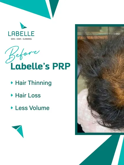 This 'before' image shows the common concerns we address: hair thinning, noticeable hair loss, and reduced volume. This is the starting point from which we create a personalized PRP treatment plan for hair restoration.