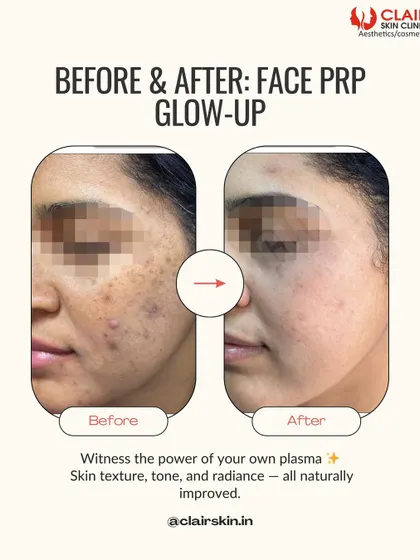 The power of PRP, or the "Vampire Facial," is on full display here. After just three sessions, this client's skin texture, tone, and radiance are all naturally improved, with a visible reduction in acne marks and dullness.
