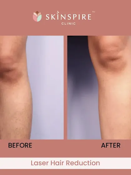 The results speak for themselves. This before-and-after image shows the significant reduction in hair growth and improved skin texture after a course of laser hair reduction sessions. Our goal is to provide a permanent solution to unwanted hair, eliminating the need for constant waxing or shaving.