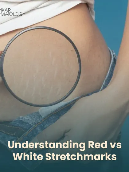 Stretch marks are a common concern, and understanding the difference between red (new) and white (old) marks is the first step. This image helps identify which type you may have, as the treatment approach differs for each.