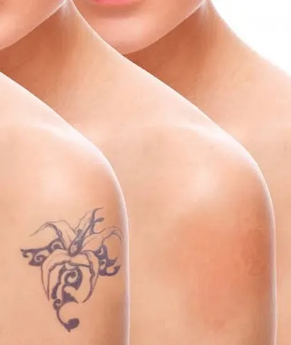 This image illustrates the gradual fading process of laser tattoo removal over multiple sessions. The laser breaks down the ink, and the body's natural processes clear it away over time. This visual represents the expected progression towards clear skin.
