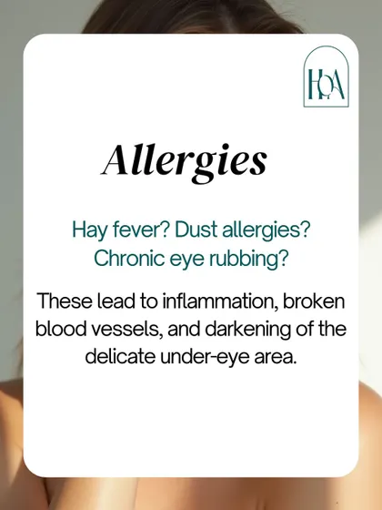 Do you suffer from allergies? Chronic eye rubbing from hay fever or dust allergies leads to inflammation, broken blood vessels, and a darkening of the delicate under-eye skin, contributing to the appearance of dark circles.