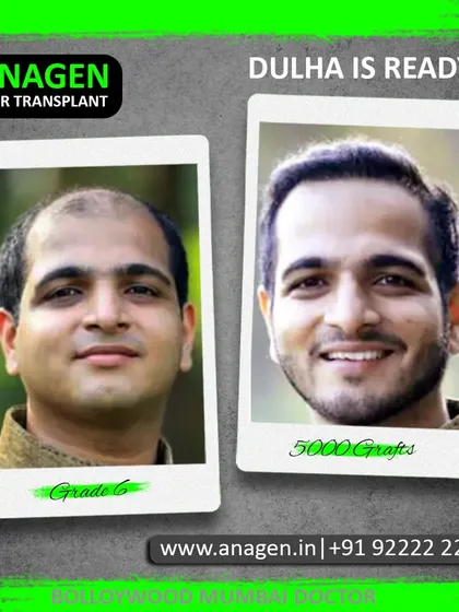 This transformation is why I do what I do. We took this patient from Grade 6 baldness to being "Dulha is Ready" with a 5000 graft procedure. Seeing this smile and renewed confidence is the ultimate reward.
