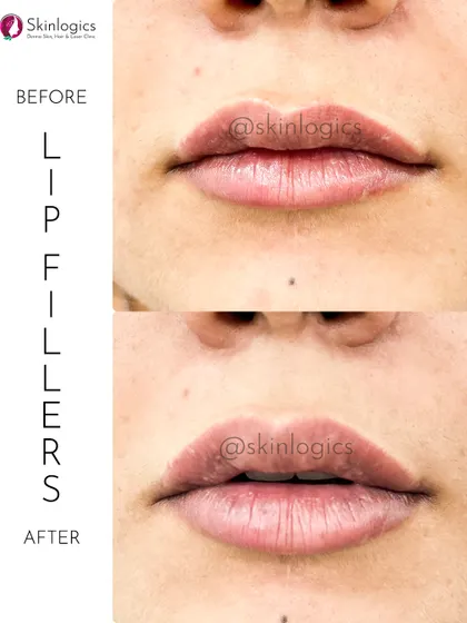 A clear example of how I approach lip fillers. The goal is always a natural enhancement, adding subtle volume and definition to create a balanced and hydrated look, not an overdone pout. This before-and-after shows a beautifully refreshed and defined lip shape.