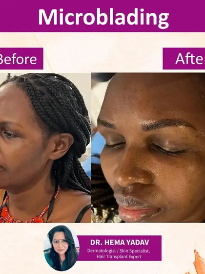 This is a great example of hyper-realistic microblading. I created fine, hair-like strokes to give these brows a fuller, more defined shape that looks completely natural and saves you time every morning.