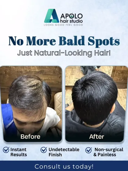 This top-down view is proof of our undetectable finish. We specialize in covering bald spots on the crown, giving our male clients the confidence that comes with a full head of hair.