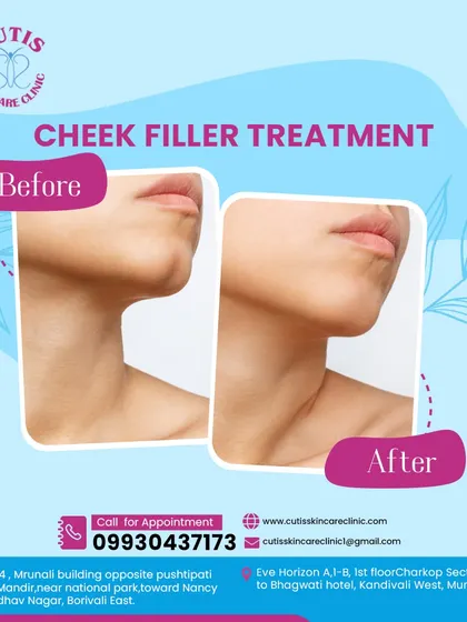 A before-and-after view of our Cheek Filler treatment. This demonstrates how we restore volume and create a subtle lift to the mid-face, enhancing the natural contours for a more defined and youthful profile.