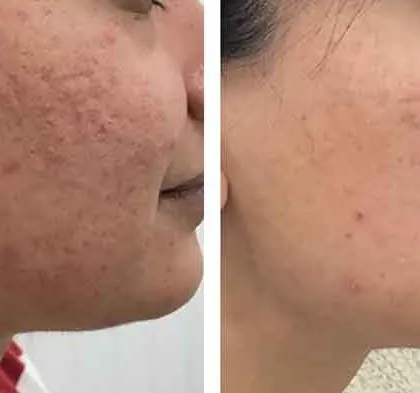 This patient's confidence soared as we progressively reduced the appearance of her acne scars. The "after" image shows not just smoother skin, but a brighter and more even complexion, thanks to a comprehensive treatment strategy.