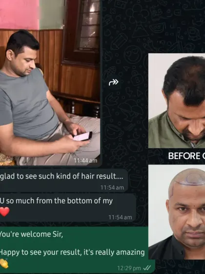 An unbelievable 5-month progress for our Delhi patient. His hairline is already visible, and confidence is restored, with full results still to come.