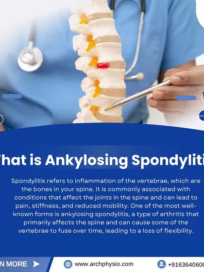 This graphic explains Ankylosing Spondylitis, a type of arthritis that affects the spine. Our physical therapy programs focus on improving flexibility and posture to manage symptoms and maintain mobility.