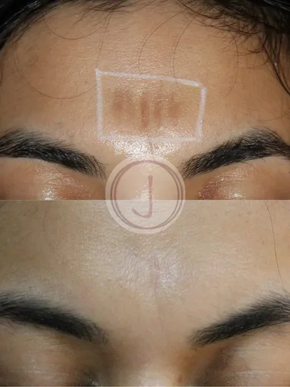 A clear view of a forehead scar before and after treatment. By combining different laser modalities, we can effectively remodel scar tissue and improve the overall appearance of the skin.