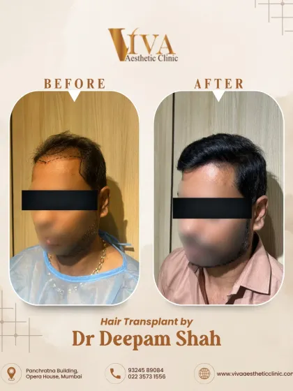 Another angle of the same patient. We focused on creating a dense frontal pack that flows naturally into the mid-scalp, giving the appearance of full, healthy hair.