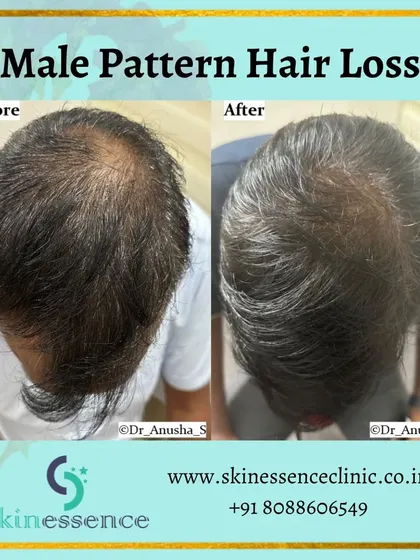 This patient was concerned about significant thinning on the crown, a common sign of male pattern hair loss. With a consistent, medically supervised routine, we were able to achieve this significant increase in hair density and coverage in just a few months, restoring his confidence.