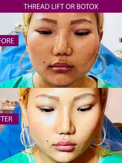 This is a great example of how a combination of treatments can achieve a significant yet natural-looking result. For this patient, I used a thread lift to contour the lower face and jawline, paired with Botox to refine the overall shape. The goal was to create a slimmer, more defined facial structure.
