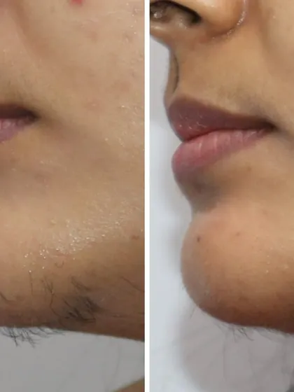This before and after image shows the results of laser hair reduction on the chin area. Hormonal changes can often lead to unwanted facial hair, and my treatment provides a lasting solution, restoring smooth skin and confidence.
