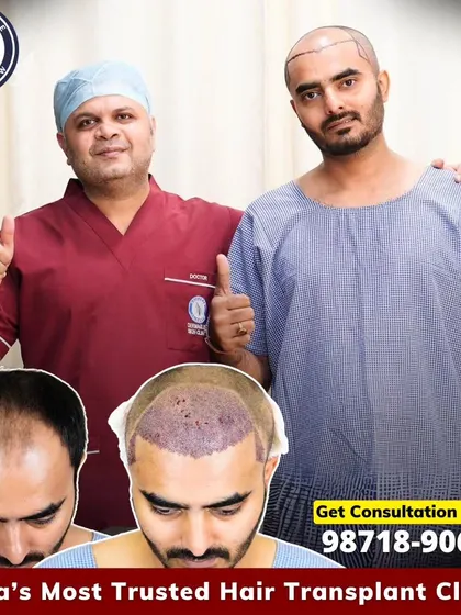 A happy doctor and a happy patient. This collage shows the journey of implanting 3858 grafts, from the pre-surgery thinning to the immediate post-operative result, on the way to a fuller look.