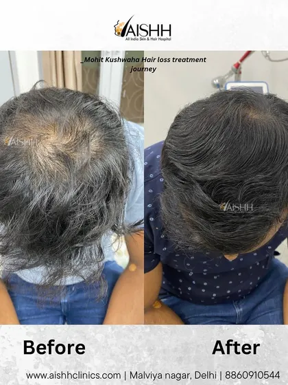 A final look at this patient's two-month transformation, demonstrating the effectiveness of consistent, targeted non-surgical therapies.