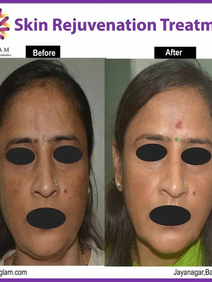 This client's transformation after a skin rejuvenation treatment plan is remarkable. The treatment effectively reduced pigmentation and sun spots, resulting in a much more even and radiant skin tone.