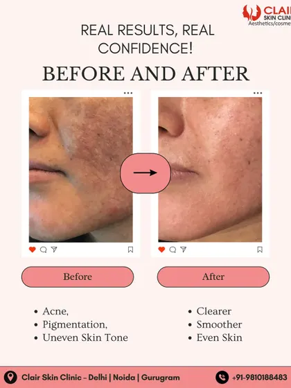 This image shows a successful outcome for a client struggling with acne, pigmentation, and uneven skin tone. The result is clearer, brighter skin with a much more uniform complexion.