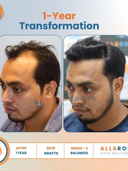 After one year, this patient's Grade 3 baldness was fully addressed with 2670 grafts. The transformation is evident in his smile and the natural, dense hairline that frames his face.