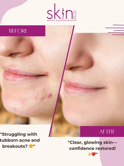 This before-and-after image shows the successful treatment of active acne and post-inflammatory redness. It illustrates how my customized plans can clear breakouts and restore skin confidence.
