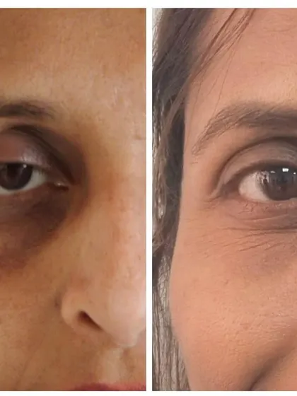 This before and after demonstrates our approach to treating under-eye pigmentation and volume loss. By addressing the specific cause, we can achieve a brighter, more rested appearance.