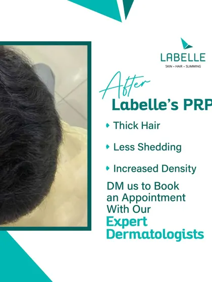 This is the 'after' view of a client's successful PRP treatment journey. In just six months, we achieved thicker hair, reduced shedding, and a significant increase in hair density, restoring both hair and confidence.
