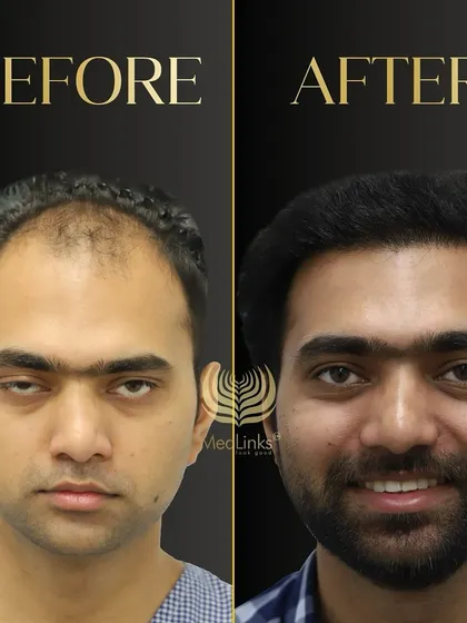 This before and after comparison shows a dramatic improvement in hair density and hairline. The patient looks younger and more confident.