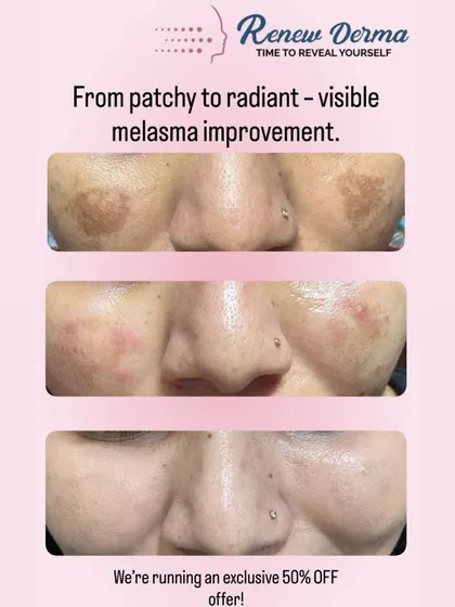 Melasma can be stubborn, but with the right approach, we see incredible improvements. This before-and-after shows a visible reduction in patchy pigmentation after a personalized treatment plan. Getting an even, radiant skin tone is absolutely possible.