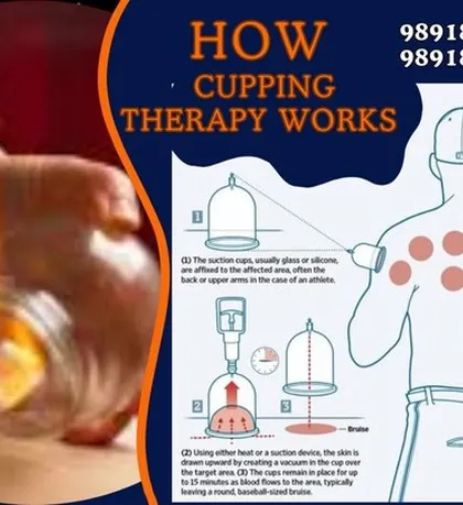 This diagram illustrates the mechanics of cupping therapy. Whether using heat or a suction device, the goal is to draw the skin upward, creating a therapeutic effect that leaves round, baseball-sized bruises which are a sign of increased blood flow.