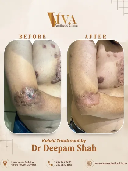 This was a challenging case of extensive and hard keloids on the chest and arm. I created a multi-step treatment plan using intralesional injections and fractional CO2 laser to break down the tough scar tissue. The 'after' photo shows a significant flattening and reduction, making the skin much smoother and more comfortable for the patient.