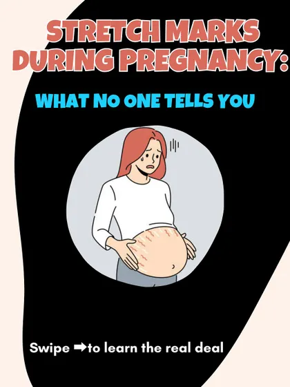 This introduces my series on what no one tells you about stretch marks during pregnancy. Let's get into the real deal.