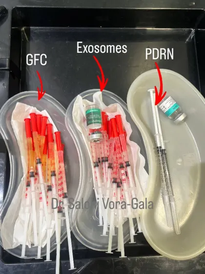 This is what science-backed hair restoration looks like. In my clinic, we use advanced regenerative treatments like GFC (Growth Factor Concentrate), Exosomes, and PDRN. These are not magic potions; they are powerful biological tools that signal your own body to heal, repair, and stimulate hair follicles at a cellular level.