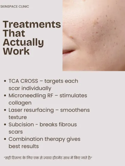 Treatments that actually work for deep scars include TCA CROSS, which targets each scar individually, and Microneedling RF to stimulate collagen. We also use laser resurfacing and subcision, often in combination, for the best possible results.