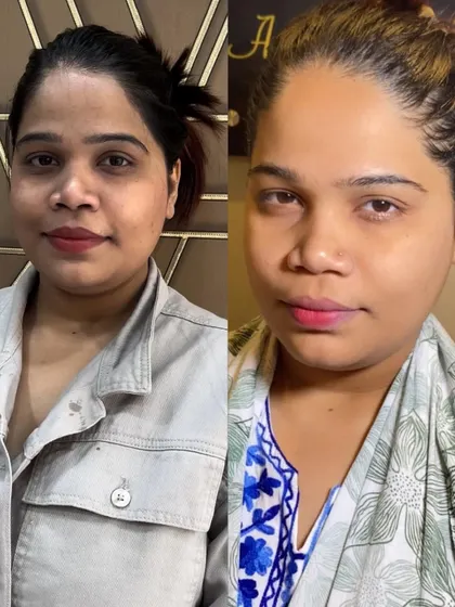 A clear example of the brightening results from my Korean Whitening Treatment. This before and after shot shows a significant reduction in dullness and a much more radiant and even skin tone.