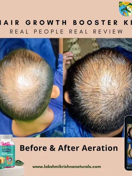 This is the kind of result that makes our work meaningful. This before and after photo shows the progress a customer made using our Hair Growth Booster Kit. You can see a visible increase in hair density and coverage over the bald patch.