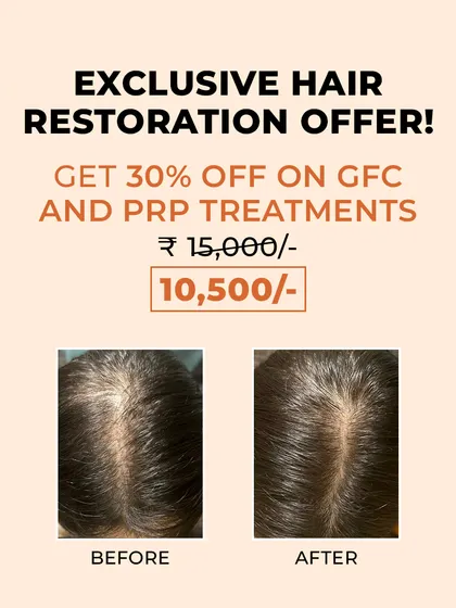 A widening hair part is a common sign of hair thinning. This before and after photo demonstrates how our targeted GFC and PRP treatments can effectively increase hair density and improve scalp coverage.